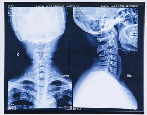 Blue Laser Medical Dry Sexy X Ray Bf Film per l' esame radiografico