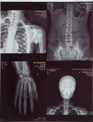 Film per raggi X medici ad alta lucidità FUJI DIHT 14*17in Laser Dry Imaging Film