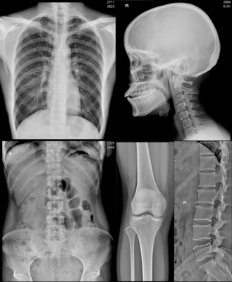 SIG. DR Digital del CR di CT impermeabile medico del film del getto di inchiostro di A3 A4 X Ray Film