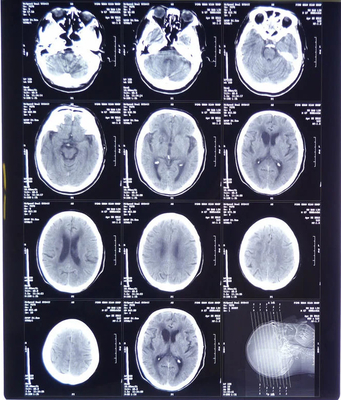 Film per raggi X medici ad alta lucidità FUJI DIHT 14*17in Laser Dry Imaging Film