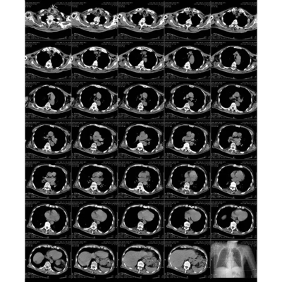 Film laser radiografico stampato con laser blu avanzato con processo di stampa termica